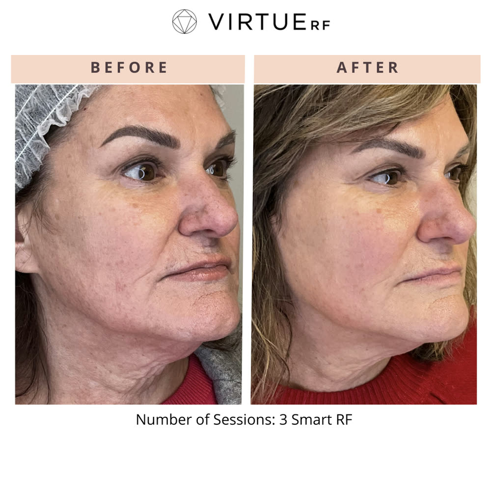 VirtueRF before and after
