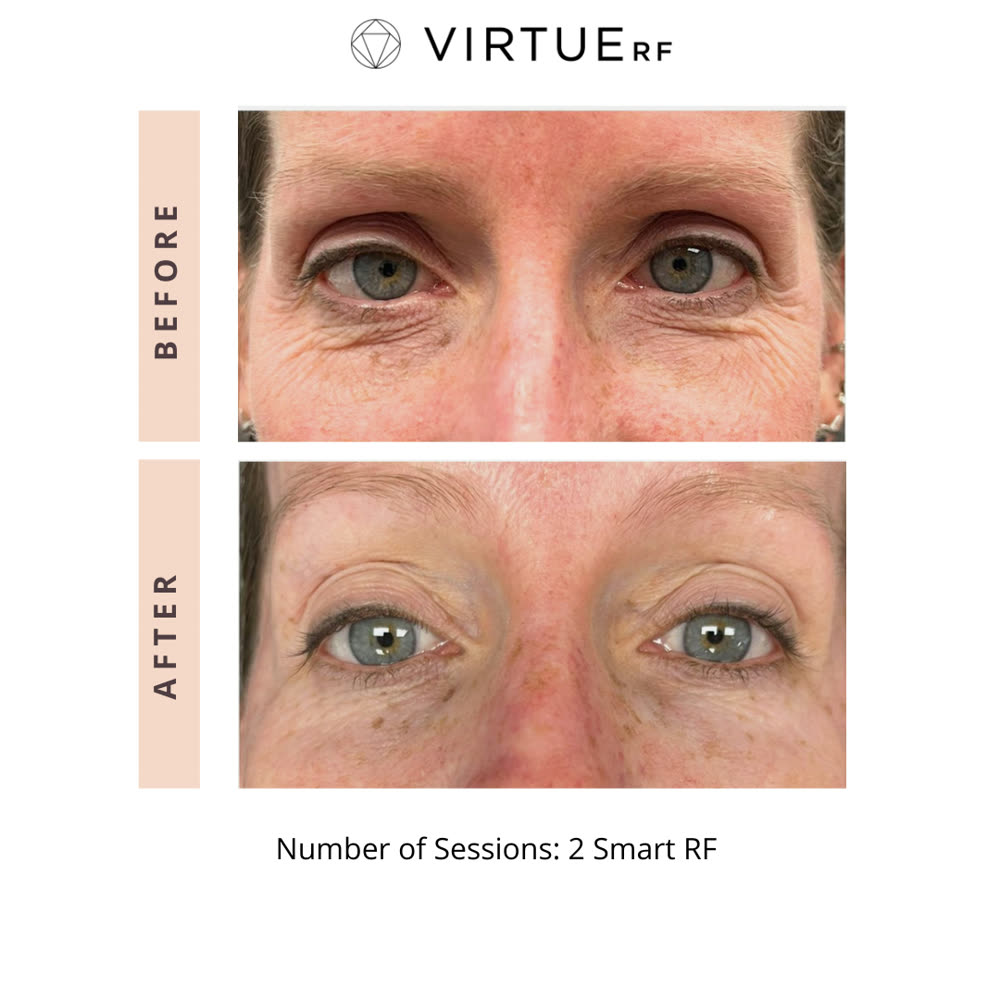 VirtueRF before and after