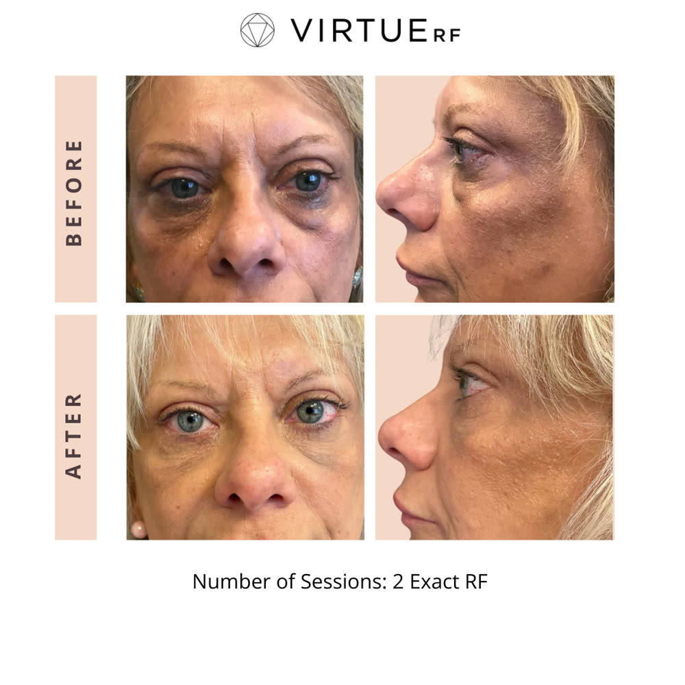 VirtueRF before and after