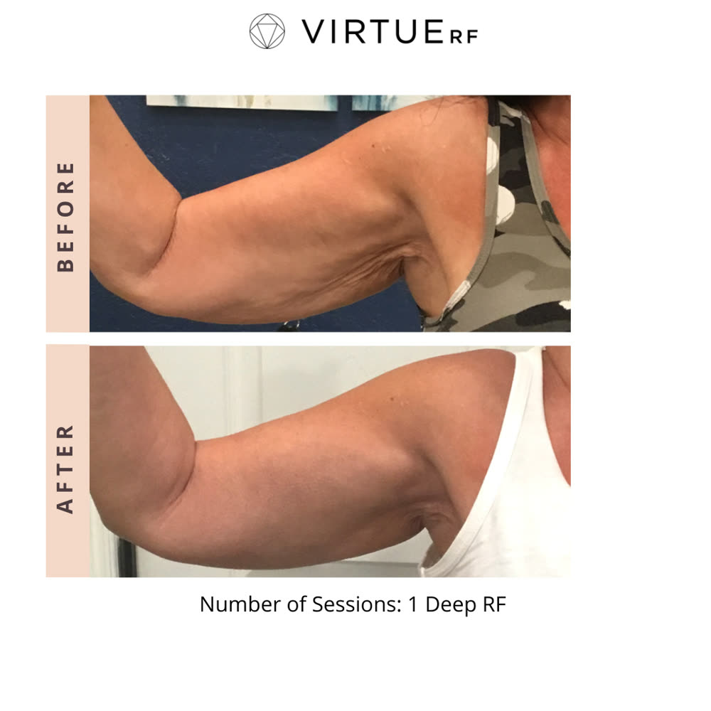 VirtueRF before and after