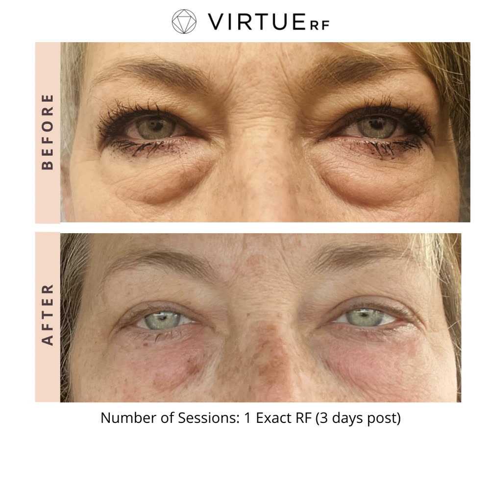 VirtueRF before and after