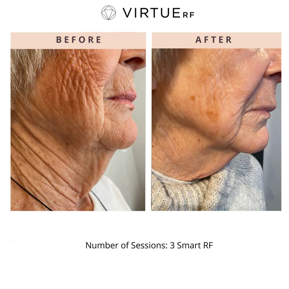 VirtueRF before and after