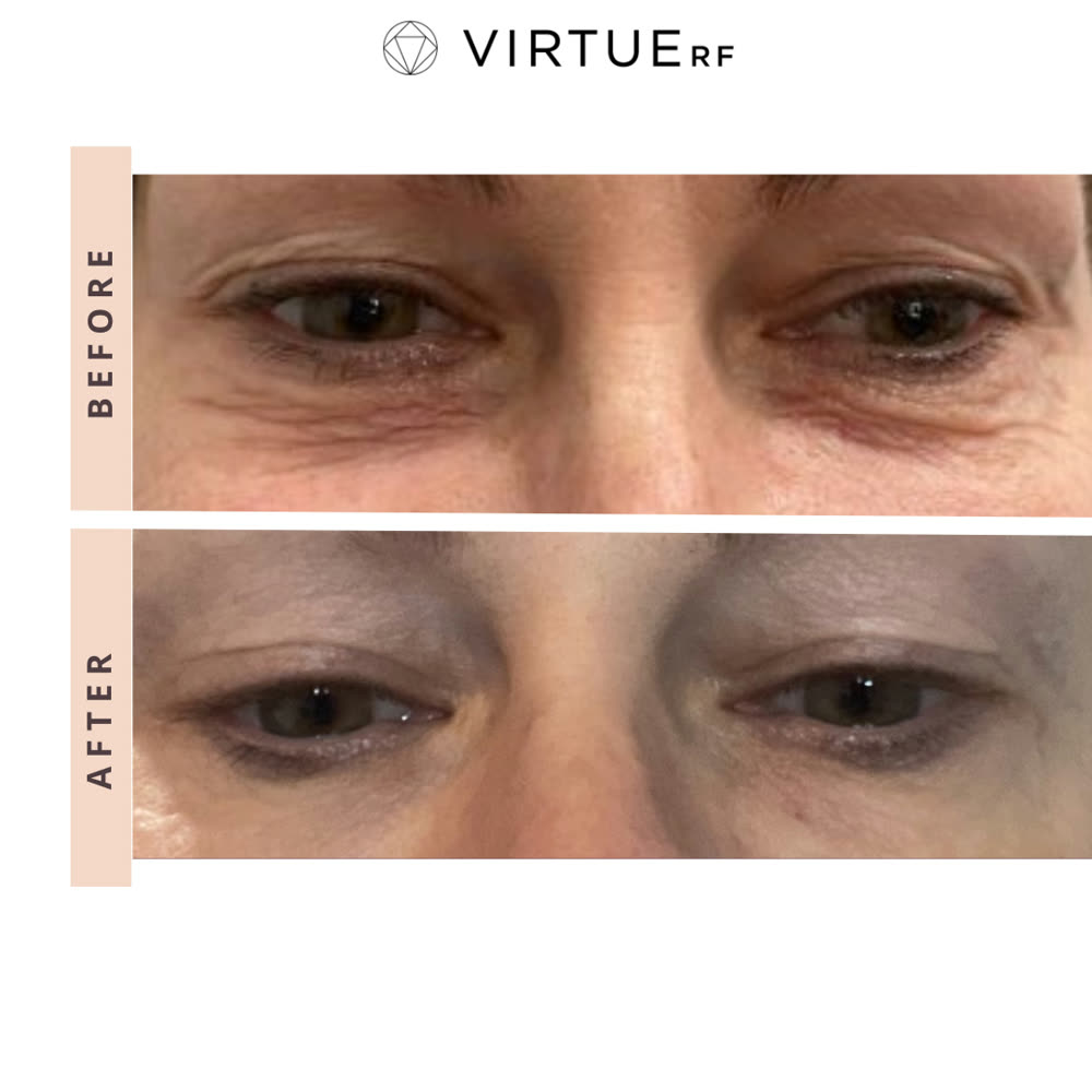 VirtueRF before and after