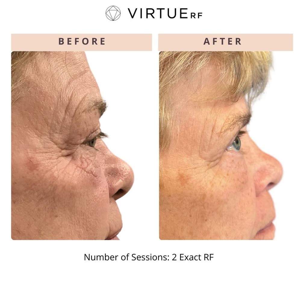 VirtueRF before and after