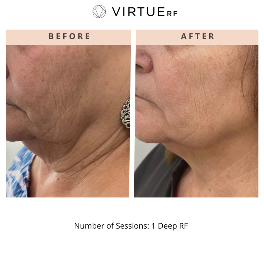 VirtueRF before and after