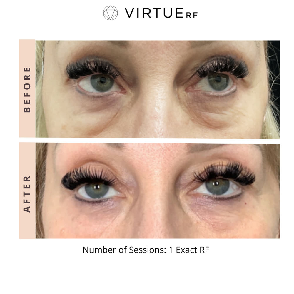 VirtueRF before and after