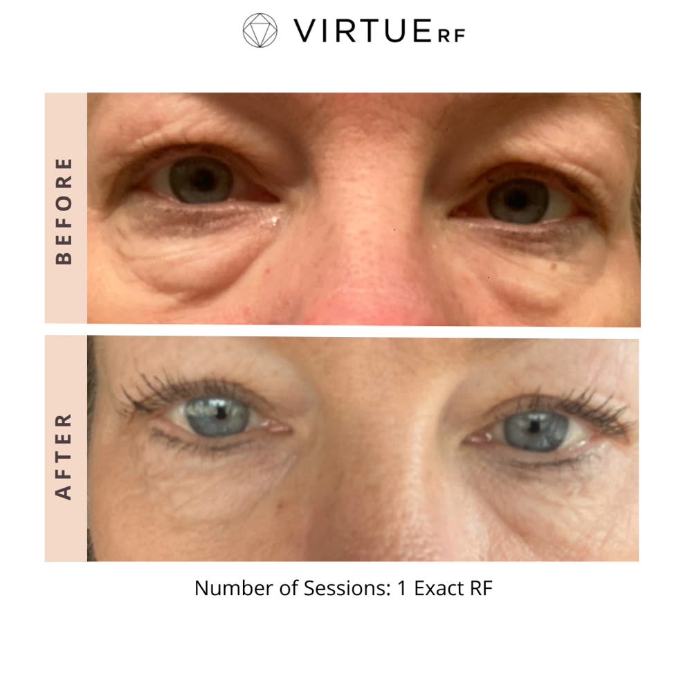 VirtueRF before and after