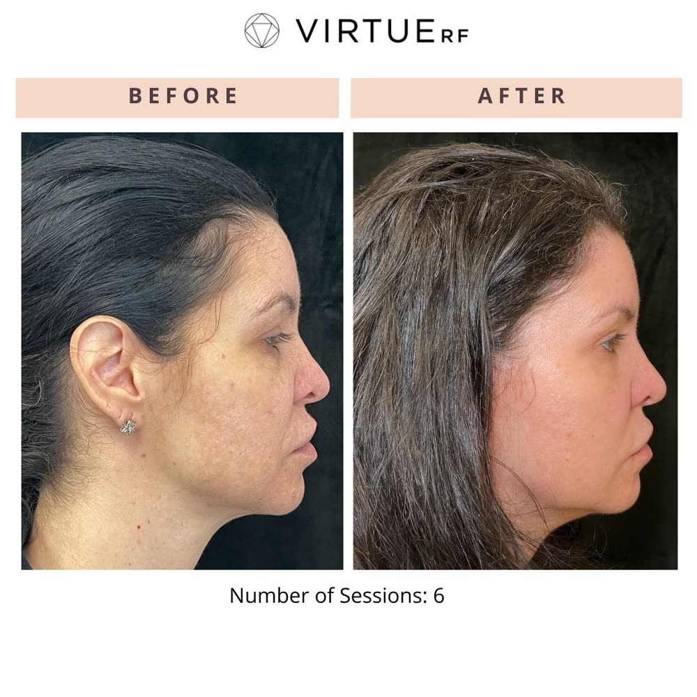 VirtueRF before and after
