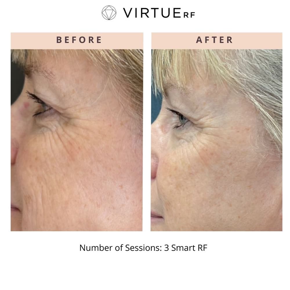 VirtueRF before and after