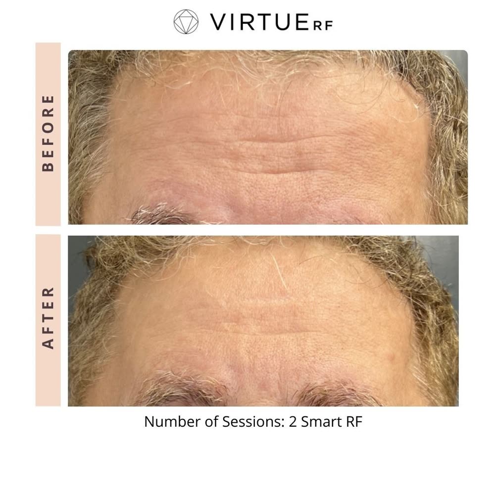 VirtueRF before and after