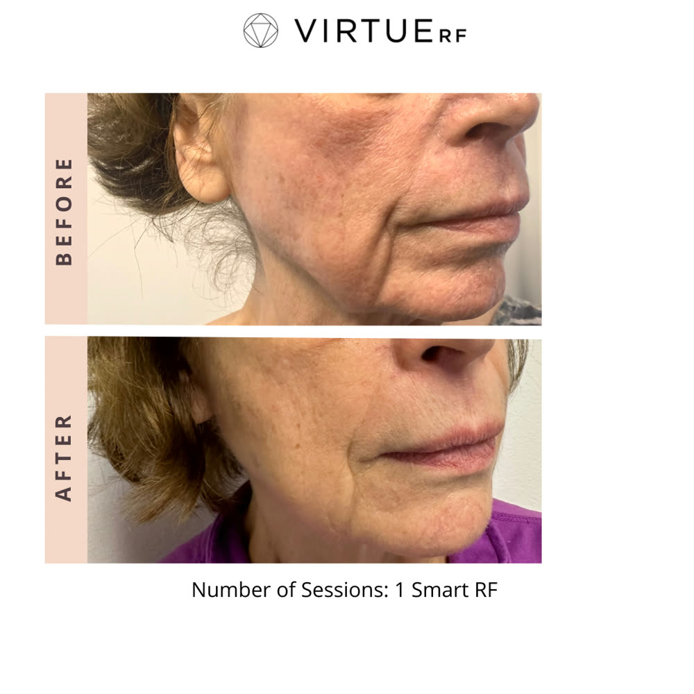 VirtueRF before and after