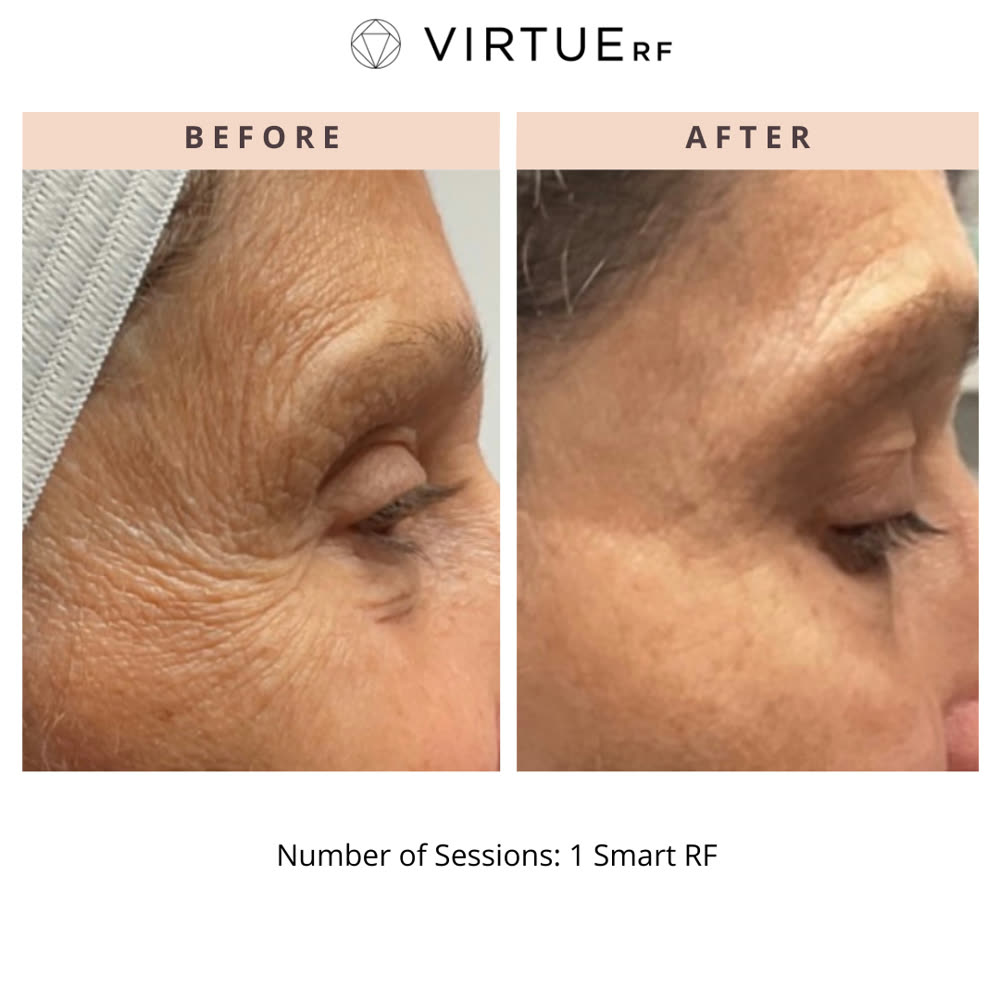 VirtueRF before and after