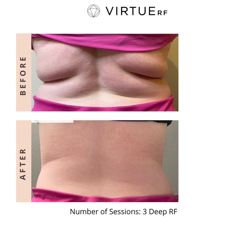 VirtueRF before and after