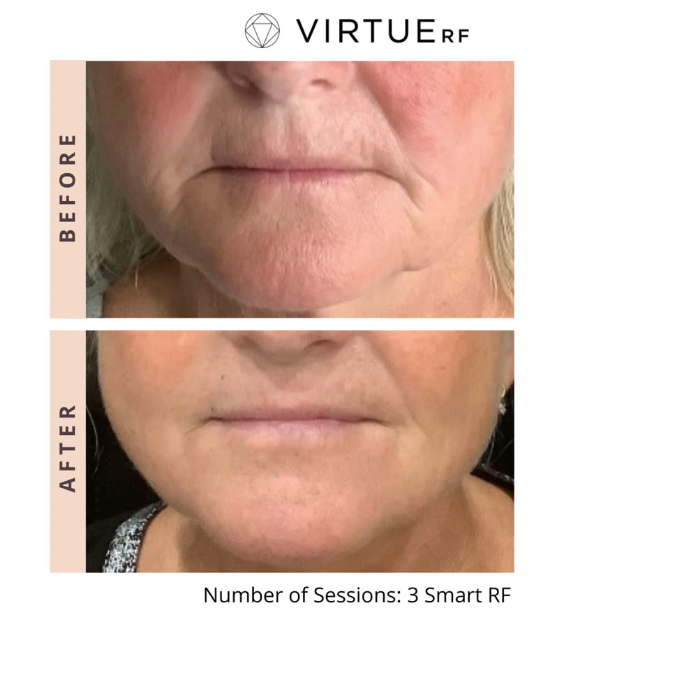 VirtueRF before and after