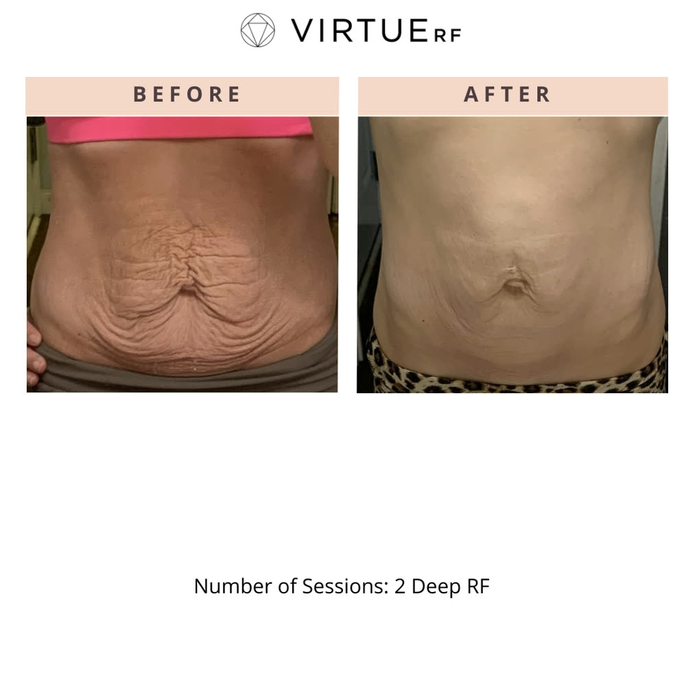 VirtueRF before and after
