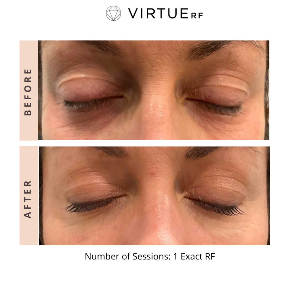 VirtueRF before and after