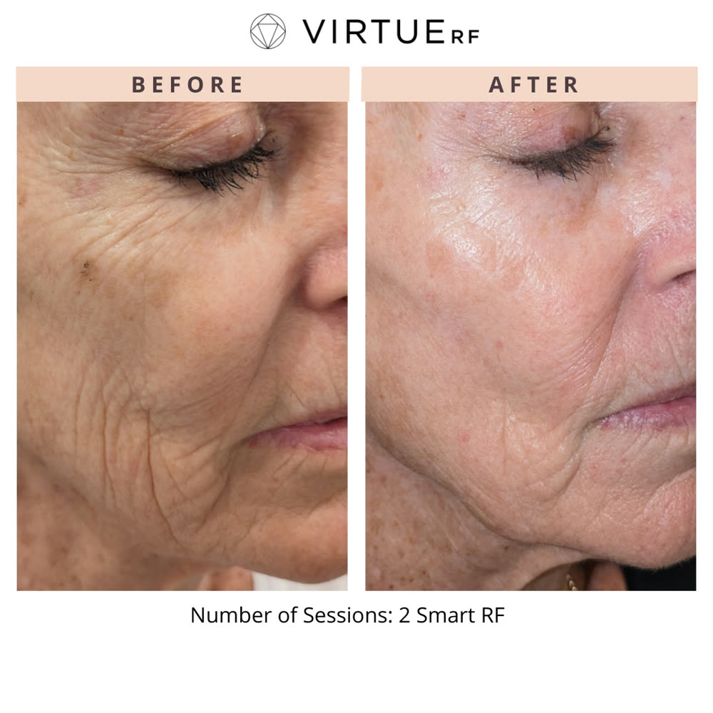 VirtueRF before and after