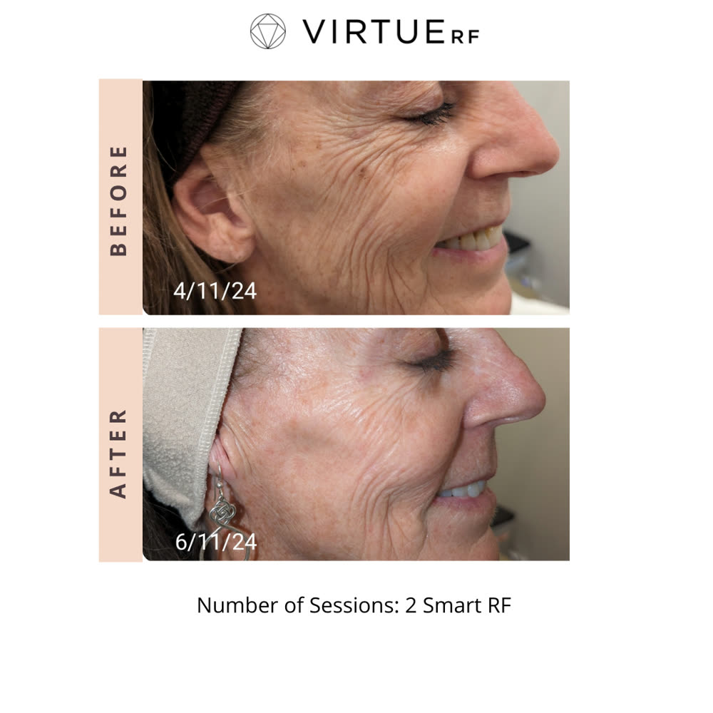 VirtueRF before and after