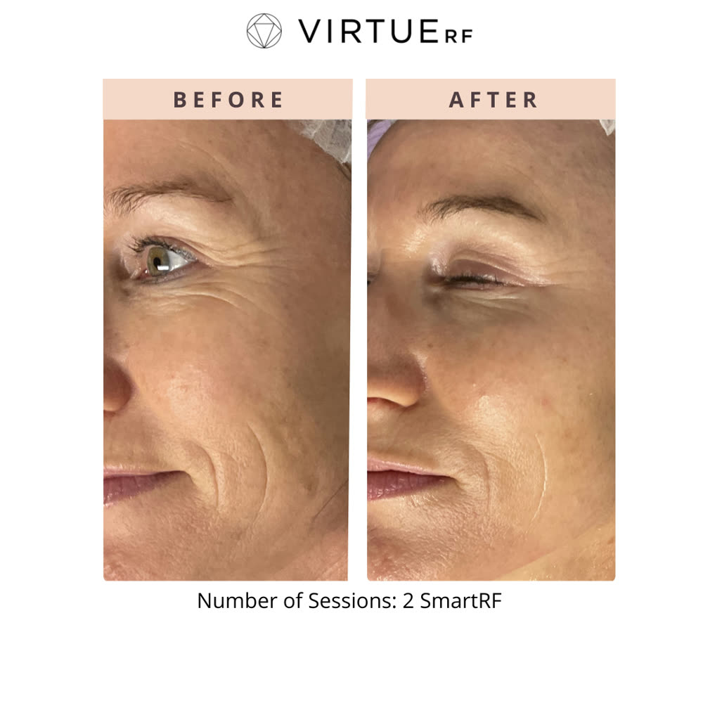 VirtueRF before and after