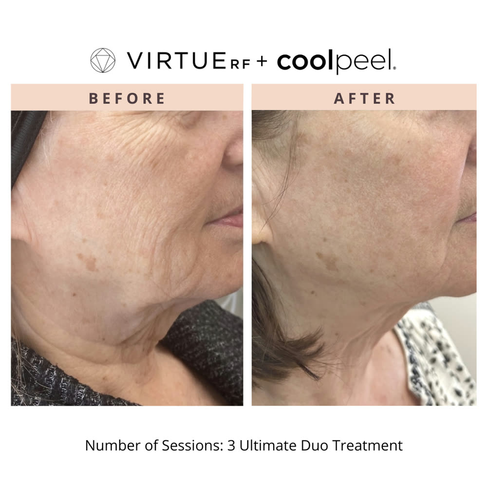 VirtueRF + CoolPeel before and after