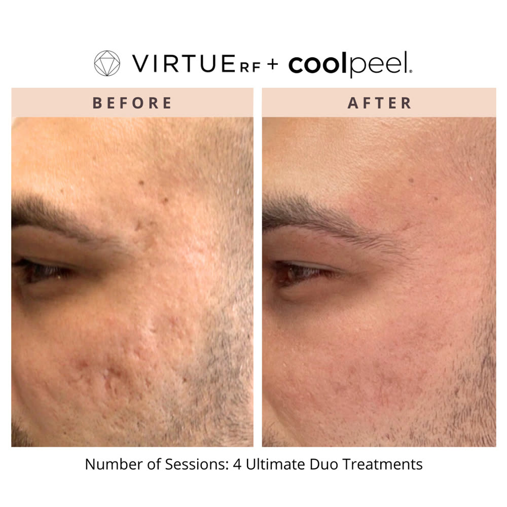 VirtueRF + CoolPeel before and after