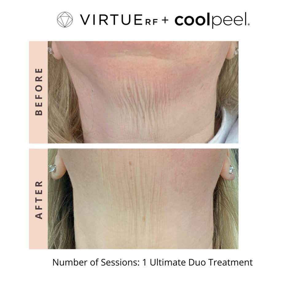 VirtueRF + CoolPeel before and after