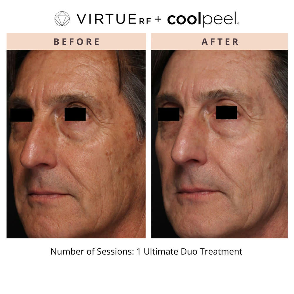 VirtueRF + CoolPeel before and after