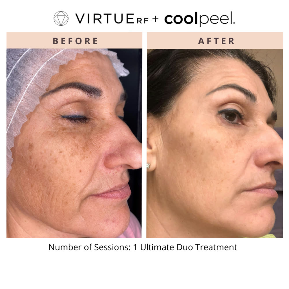 VirtueRF + CoolPeel before and after