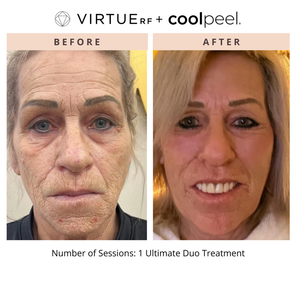 VirtueRF + CoolPeel before and after