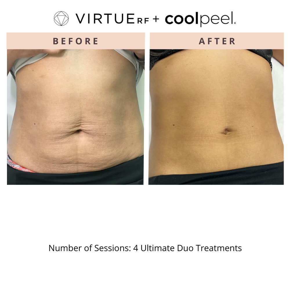 VirtueRF + CoolPeel before and after