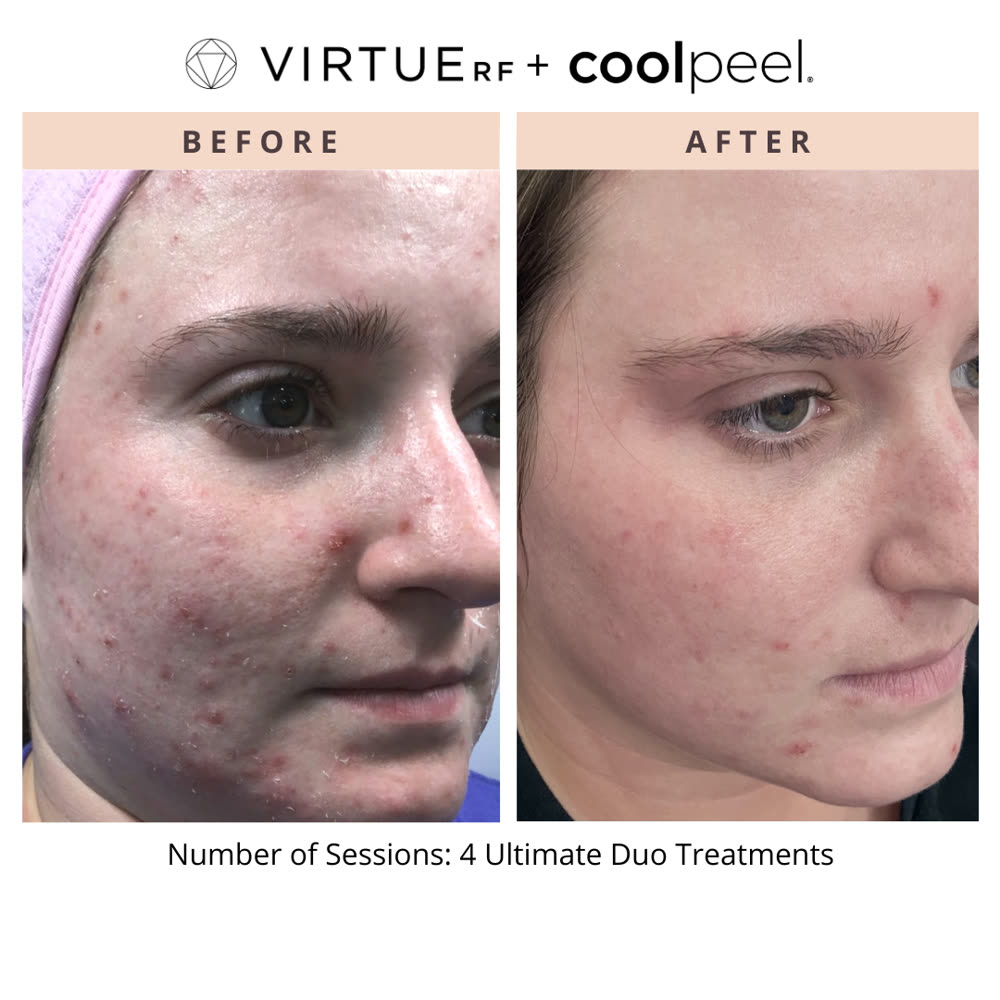 VirtueRF + CoolPeel before and after