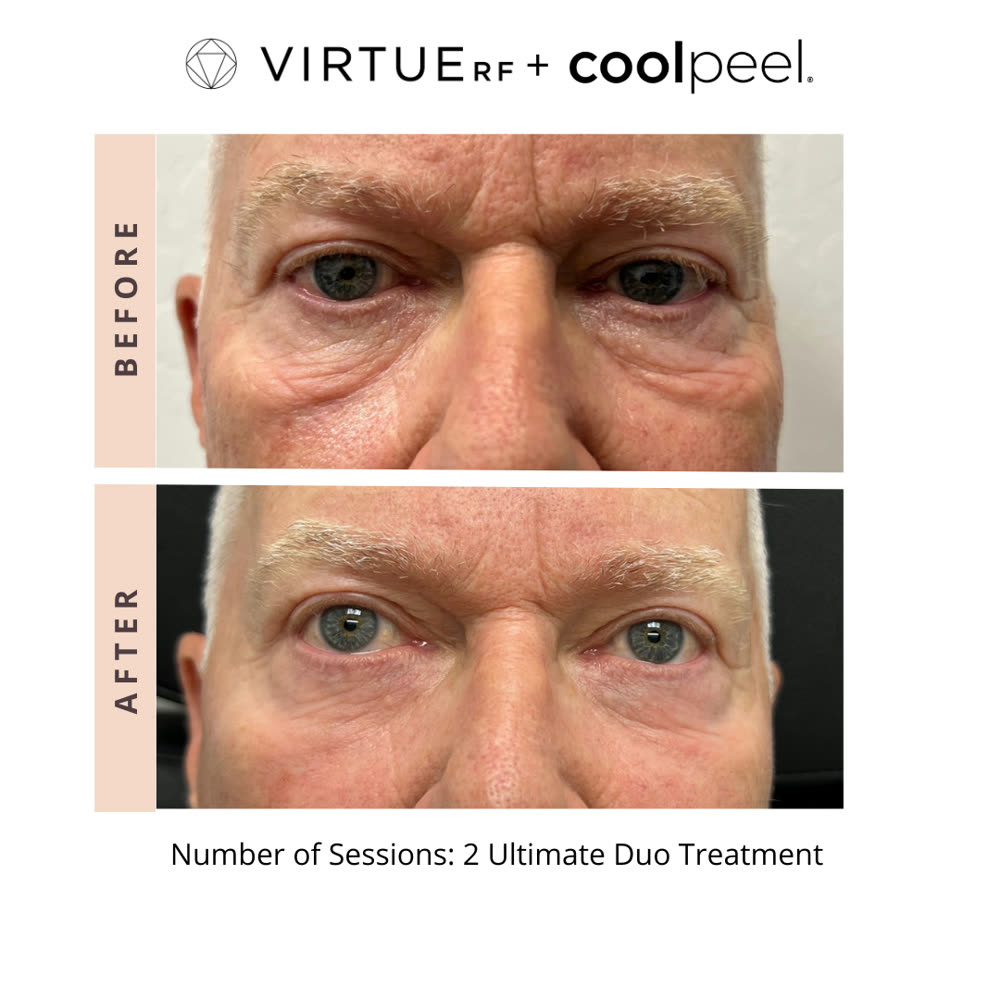VirtueRF + CoolPeel before and after