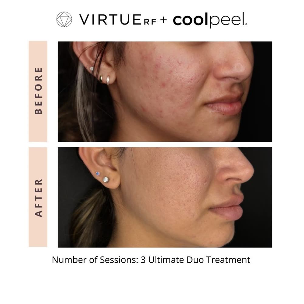 VirtueRF + CoolPeel before and after