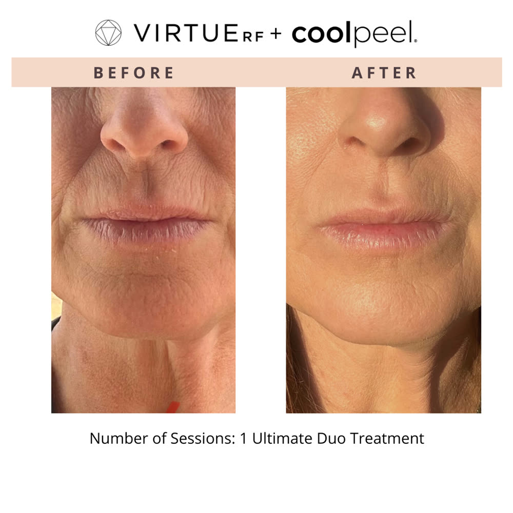 VirtueRF + CoolPeel before and after