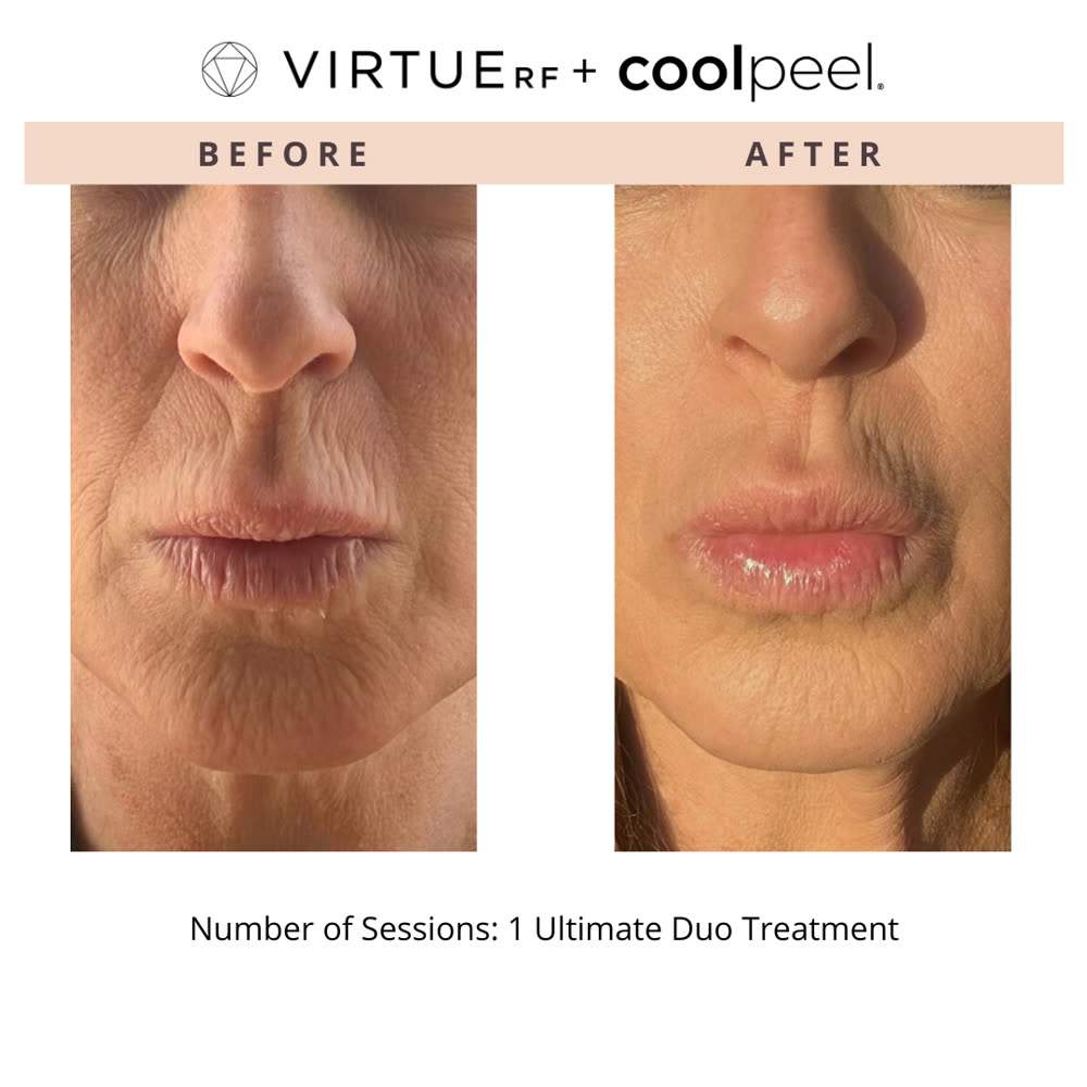 VirtueRF + CoolPeel before and after