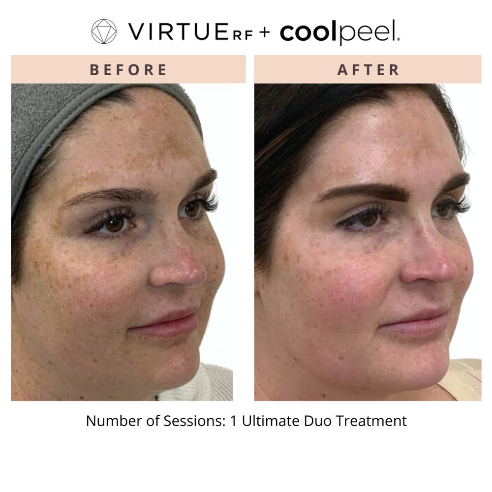 VirtueRF + CoolPeel before and after