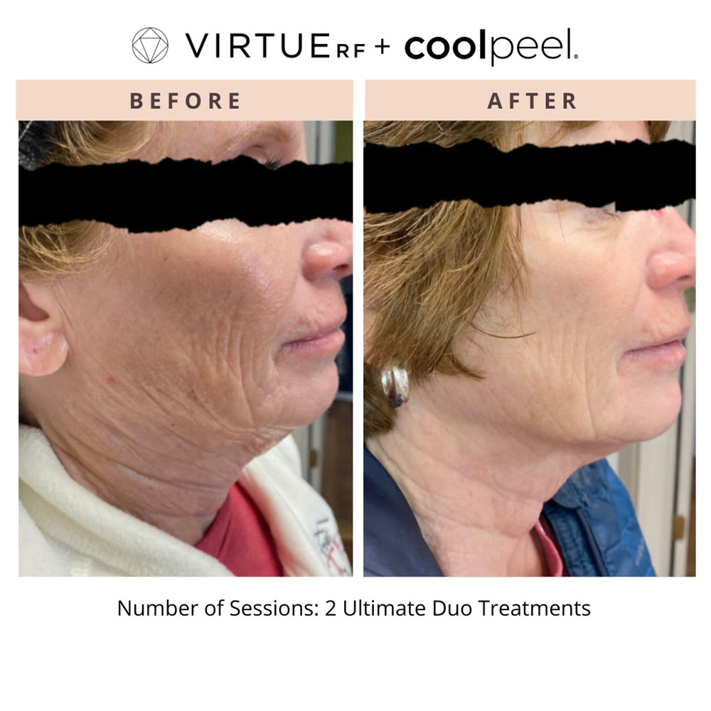 VirtueRF + CoolPeel before and after