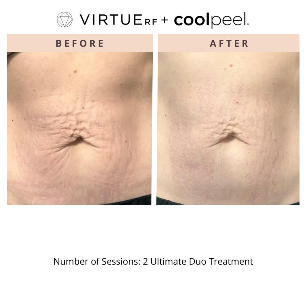 VirtueRF + CoolPeel before and after