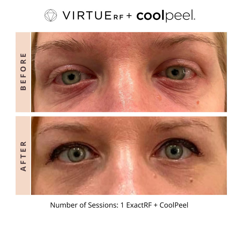 VirtueRF + CoolPeel before and after