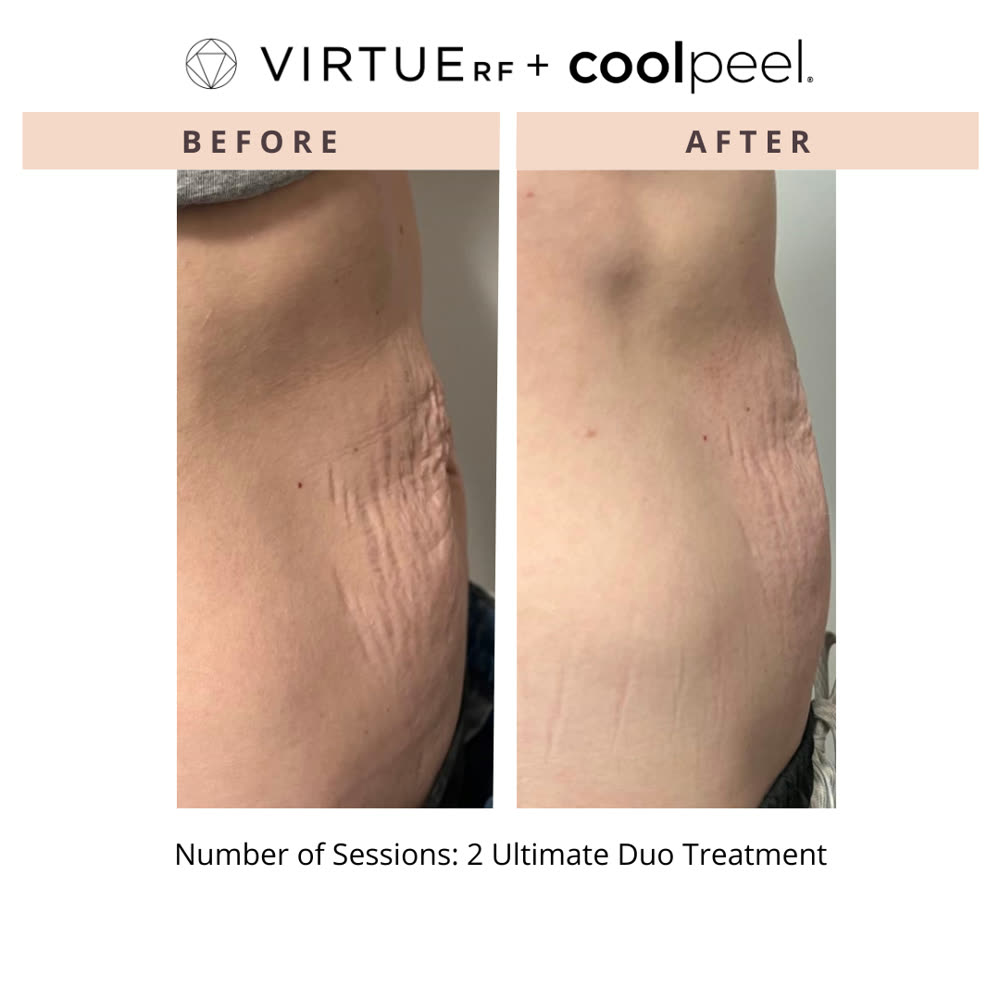 VirtueRF + CoolPeel before and after