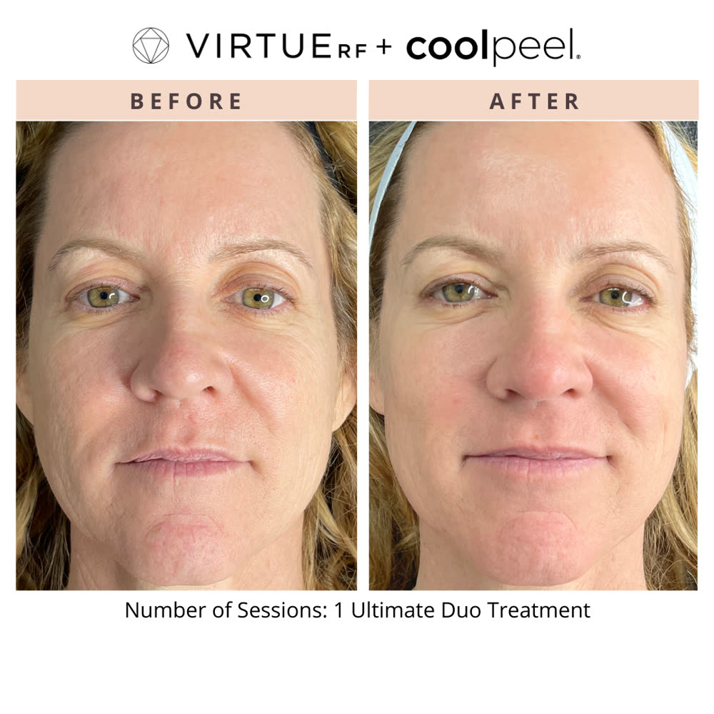 VirtueRF + CoolPeel before and after
