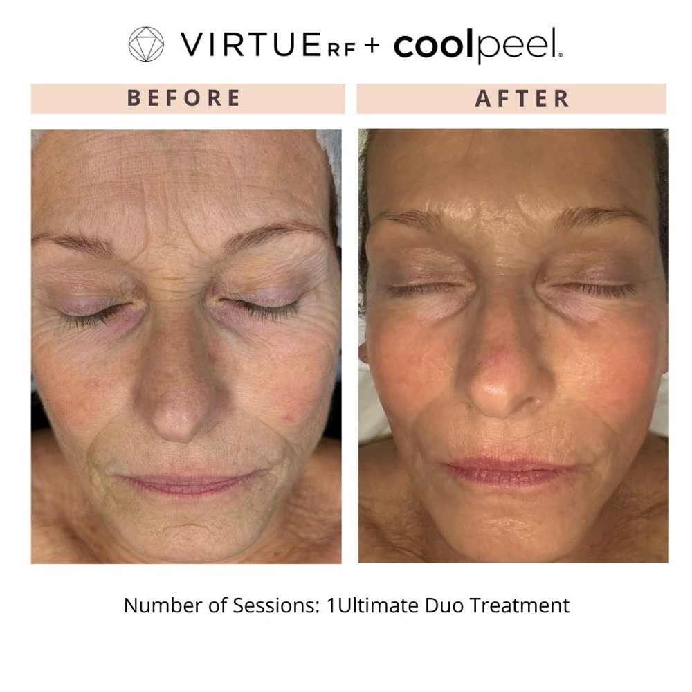 VirtueRF + CoolPeel before and after