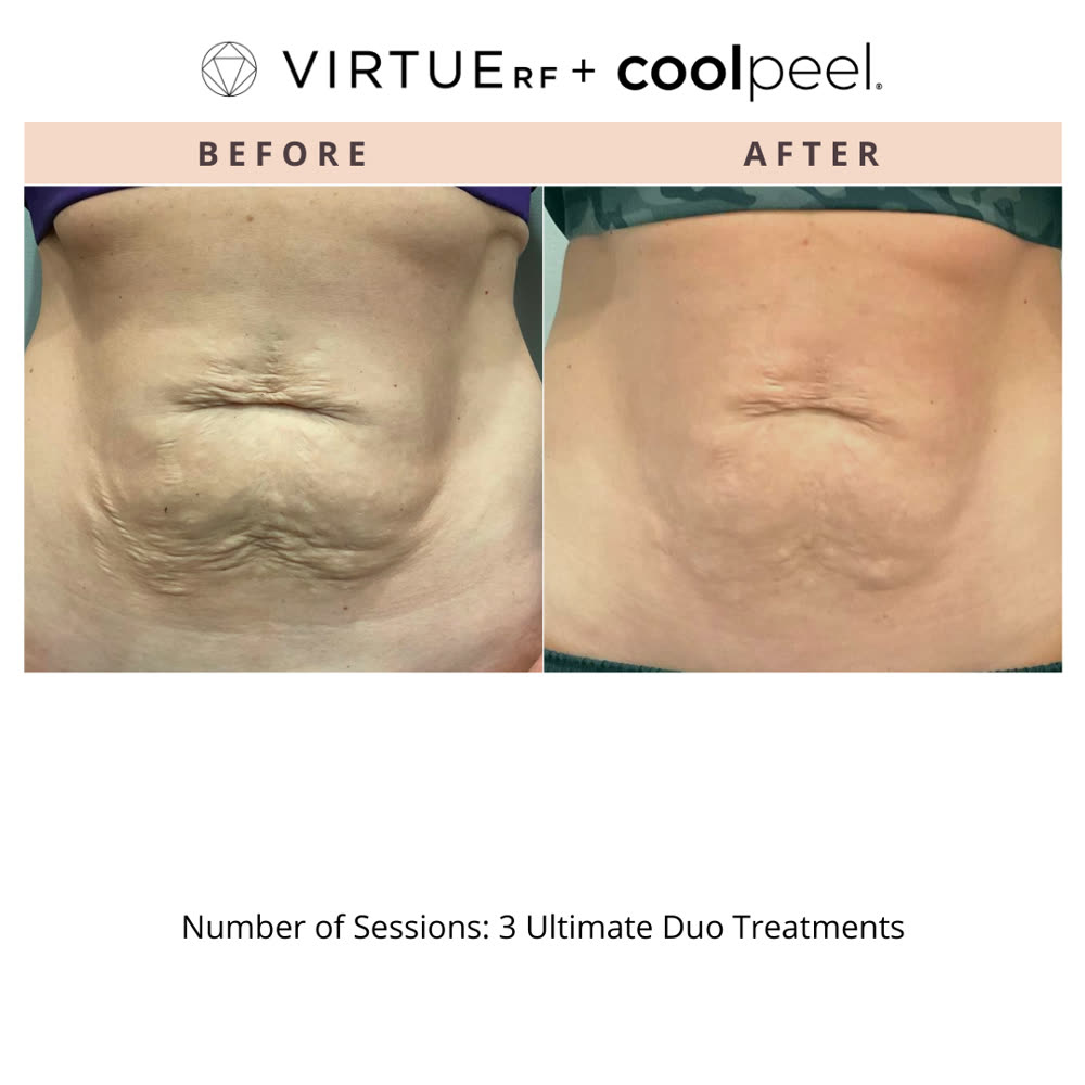 VirtueRF + CoolPeel before and after