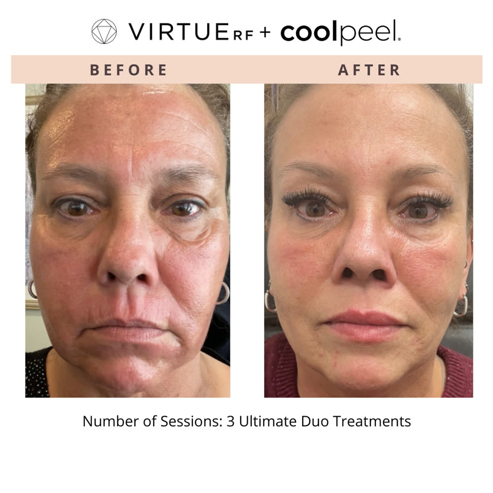 VirtueRF + CoolPeel before and after