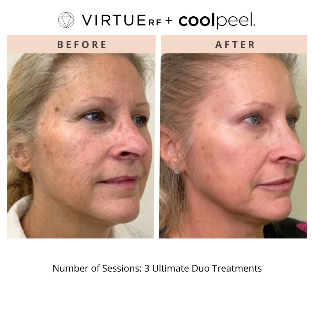 VirtueRF + CoolPeel before and after