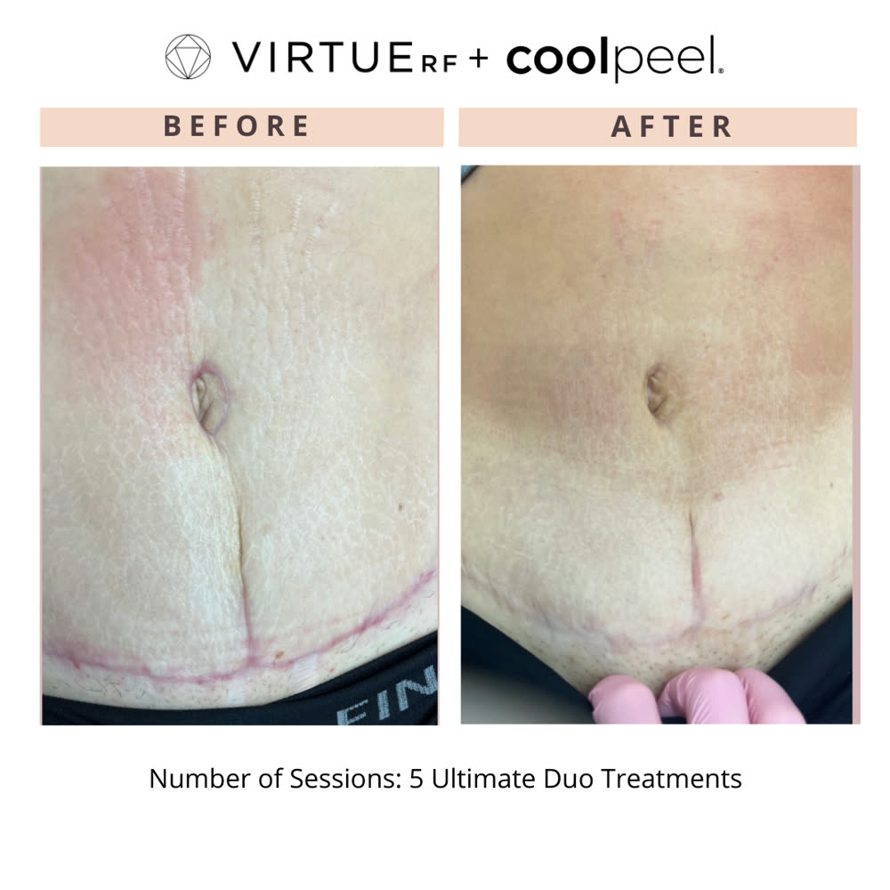 VirtueRF + CoolPeel before and after