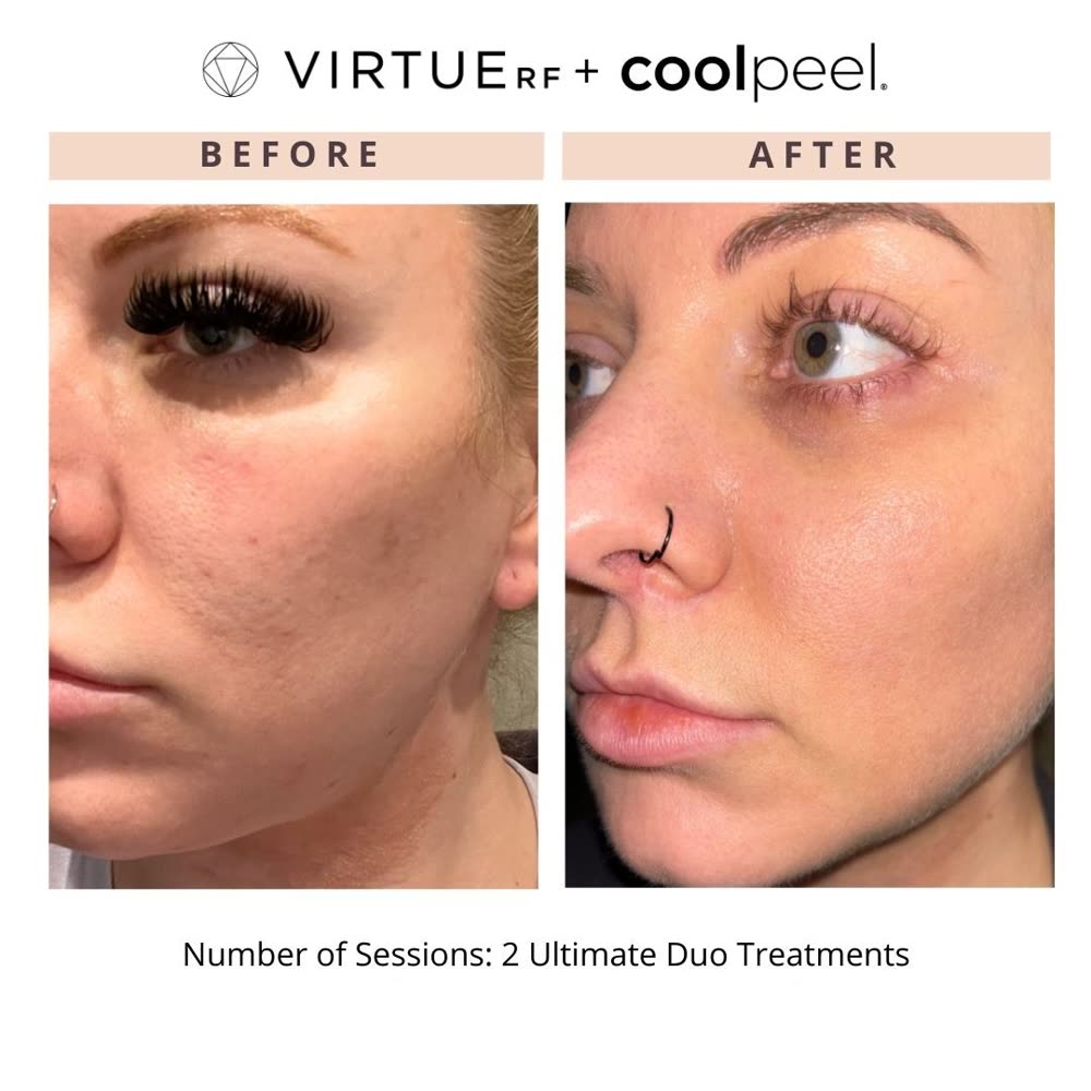 VirtueRF + CoolPeel before and after