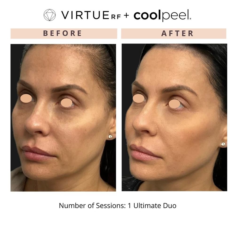 VirtueRF + CoolPeel before and after