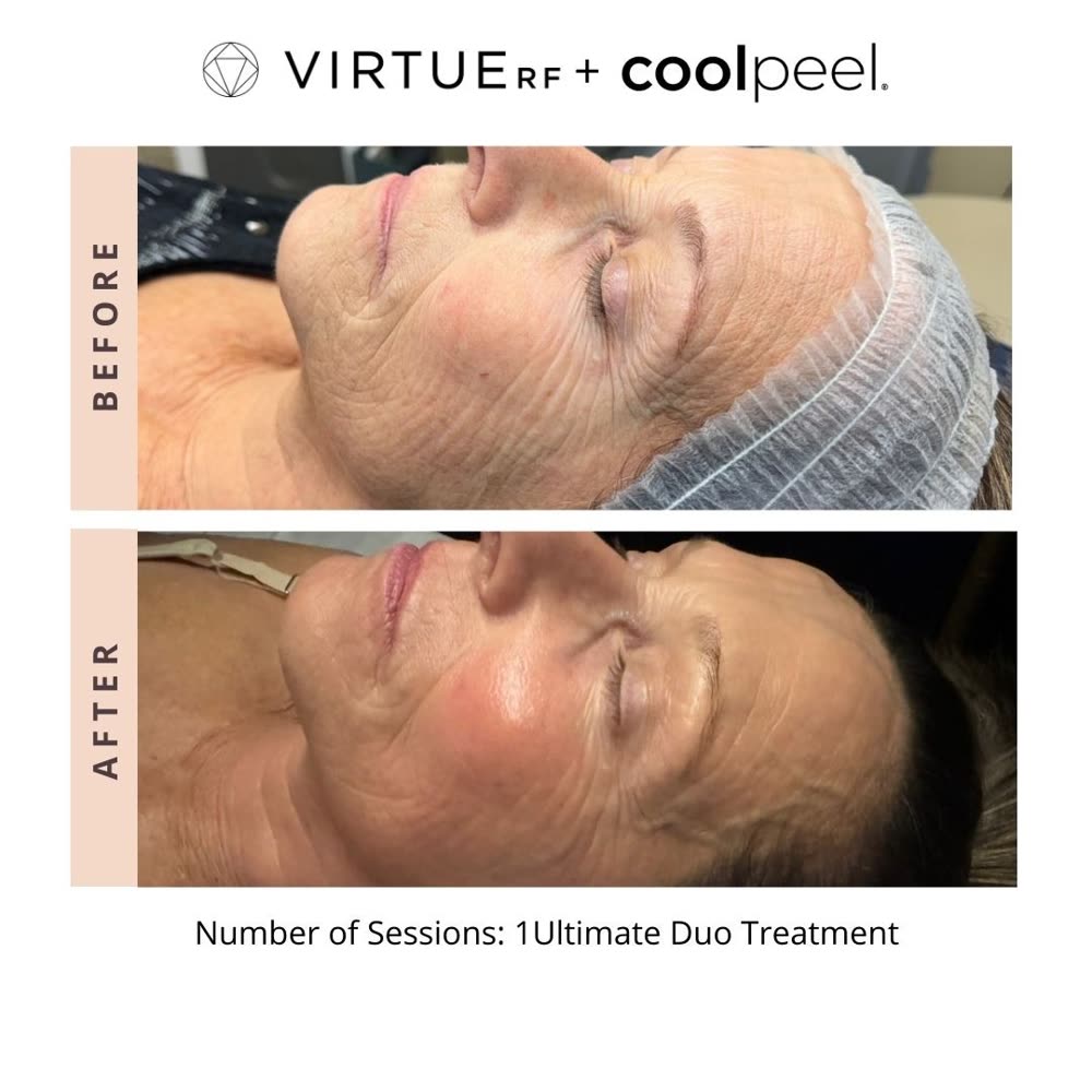 VirtueRF + CoolPeel before and after