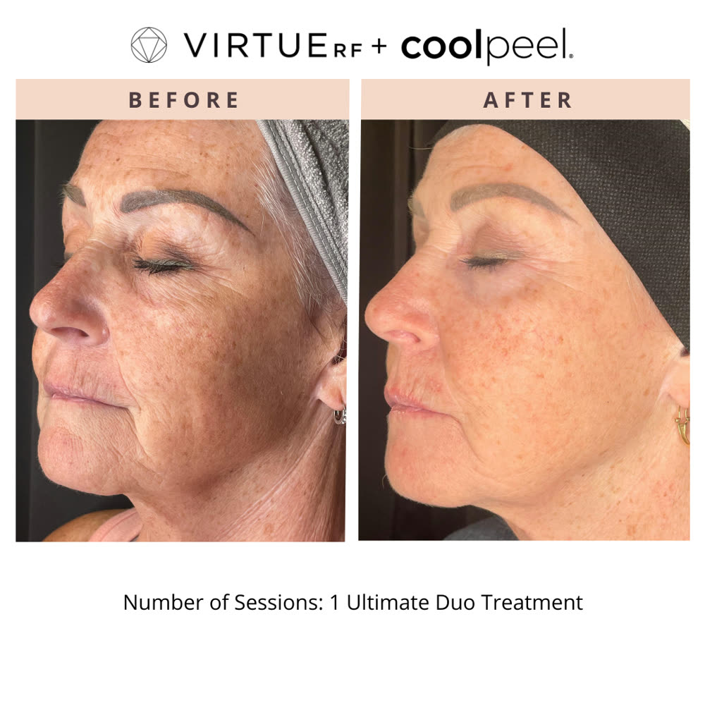 VirtueRF + CoolPeel before and after